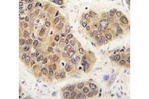 IHC analysis of FFPE human hepatocarcinoma tissue stained with SUMO4 antibody