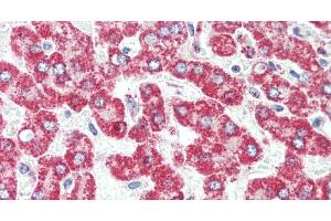 Immunohistochemistry of paraffin-embedded Human liver cancer using HSD17B8 Polyclonal Antibody at dilution of 1:100.