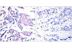 Immunohistochemistry analysis of paraffin-embedded human breast carcinoma, using c-Jun (Phospho-Thr93) Antibody. (C-JUN anticorps  (pThr93))