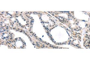 Immunohistochemistry of paraffin-embedded Human thyroid cancer tissue using KDM5C Polyclonal Antibody at dilution 1:45 (KDM5C anticorps)