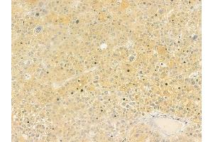 ABIN6260416 and ABIN6279231 at 1/100 staining human hepatocellular carcinoma by IHC-P. (CALML6 anticorps  (Internal Region))