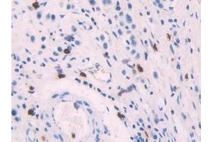 Detection of PF4 in Human Stomach cancer Tissue using Polyclonal Antibody to Platelet Factor 4 (PF4) (PF4 anticorps  (AA 31-101))