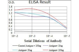 Immunohistochemical analysis of paraffin-embedded bladder cancer tissues using SLC2A4 antibody with DAB staining.