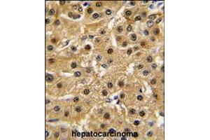 Formalin-fixed and paraffin-embedded human hepatocarcinoma tissue reacted with ABL1 antibody , which was peroxidase-conjugated to the secondary antibody, followed by DAB staining. (ABL1 anticorps  (AA 741-769))