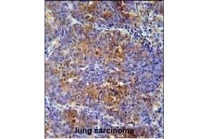 MCAF2 Antibody (Center) (ABIN654466 and ABIN2844199) immunohistochemistry analysis in formalin fixed and paraffin embedded human lung carcinoma followed by peroxidase conjugation of the secondary antibody and DAB staining.