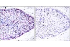 Immunohistochemistry analysis of paraffin-embedded human breast carcinoma tissue, using ATF2 (Ab-62 or 44) Antibody. (ATF2 anticorps  (AA 29-78))