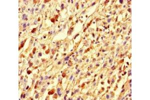 Immunohistochemistry of paraffin-embedded human melanoma using ABIN7153773 at dilution of 1:100 (GMIP anticorps  (AA 719-858))