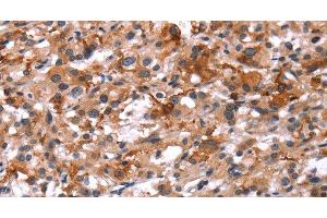 Immunohistochemistry of paraffin-embedded Human thyroid cancer using Glucagon Receptor Polyclonal Antibody at dilution of 1:40 (Glucagon Receptor anticorps)