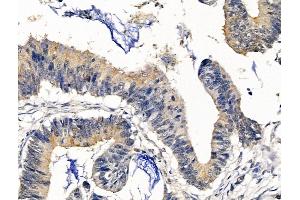 ABIN7094733 and ABIN7098784 at 1/100 staining Human colorectal cancer by IHC-P.