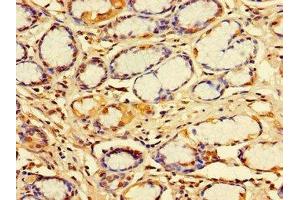 Immunohistochemistry of paraffin-embedded human gastric cancer using ABIN7156344 at dilution of 1:100 (IDE anticorps  (AA 501-800))