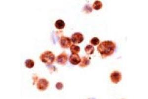Imunohistochemical analysis of human alveolar macrophages, using MSR1 monoclonal antibody, clone SRA-C6  . (Macrophage Scavenger Receptor 1 anticorps)