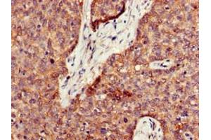 Immunohistochemistry of paraffin-embedded human ovarian cancer using ABIN7162531 at dilution of 1:100