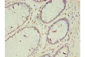 Immunohistochemistry of paraffin-embedded human colon cancer using ABIN7175400 at dilution of 1:100 (Vasohibin 2 anticorps  (AA 1-156))