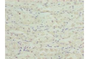 Immunohistochemistry of paraffin-embedded human gastric cancer using ABIN7171874 at dilution of 1:100 (TSPAN33 anticorps  (AA 118-235))