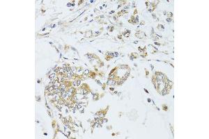 Immunohistochemistry of paraffin-embedded human gastric cancer using MAD2L2 antibody (ABIN6003593) at dilution of 1/100 (40x lens). (MAD2L2 anticorps)