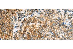 Immunohistochemistry of paraffin-embedded Human cervical cancer tissue using TUFT1 Polyclonal Antibody at dilution of 1:120(x200)