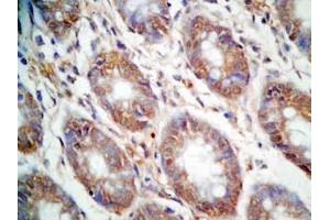 Human colon cancer tissue was stained by Rabbit Anti-CCK (26-33)  (Human,Rat) Antibody