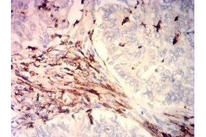 Immunohistochemical analysis of paraffin-embedded cervical cancer tissues using CD14 mouse mAb with DAB staining.