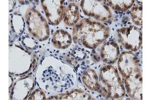 Immunohistochemical staining of paraffin-embedded Adenocarcinoma of Human endometrium tissue using anti-GAS7 mouse monoclonal antibody. (GAS7 anticorps)