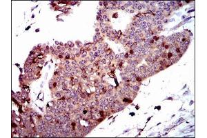Immunohistochemical analysis of paraffin-embedded ovarian cancer tissues using PBK mouse mAb with DAB staining.