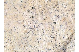 ABIN6259512 and ABIN6273965 at 1/100 staining human hepatocellular carcinoma by IHC-P.