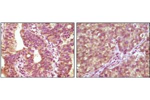 Immunohistochemical analysis of paraffin-embedded human bladder carcinoma tissue(left) and lung carcinoma tissue (right) showing cytoplasmic localization using BRAF mouse mAb with DAB staining. (BRAF anticorps)