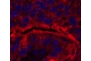 Immunofluorescence analysis of Human liver cancer tissue using CD15 Monoclonal Antibody at dilution of 1:200. (CD15 anticorps)