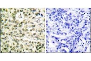 Immunohistochemistry analysis of paraffin-embedded human breast carcinoma tissue, using PCNA Antibody. (PCNA anticorps  (AA 61-110))