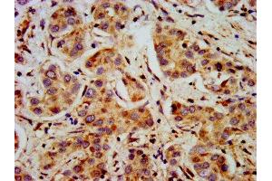 IHC image of ABIN7169467 diluted at 1:400 and staining in paraffin-embedded human liver cancer performed on a Leica BondTM system. (SHANK2 anticorps  (AA 728-822))