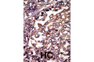 Formalin-fixed and paraffin-embedded human hepatocellular carcinoma tissue reacted with PRKAR1A polyclonal antibody  , which was peroxidase-conjugated to the secondary antibody, followed by AEC staining. (PRKAR1A anticorps  (N-Term))