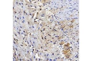 Immunohistochemistry of paraffin embedded human colon cancer using HSP60 (ABIN7074167) at dilution of 1: 1500 (300x lens)