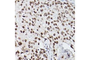 Immunohistochemistry of paraffin-embedded human breast cancer using PSME3 Rabbit pAb (ABIN6135015, ABIN6146357, ABIN6146358 and ABIN6216428) at dilution of 1:100 (40x lens).