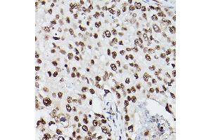 Immunohistochemistry of paraffin-embedded human breast cancer using PSME3 Rabbit pAb (ABIN6135015, ABIN6146357, ABIN6146358 and ABIN6216428) at dilution of 1:100 (40x lens). (PSME3 anticorps  (C-Term))