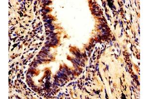 IHC image of ABIN7168493 diluted at 1:600 and staining in paraffin-embedded human lung cancer performed on a Leica BondTM system.