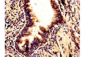 IHC image of ABIN7168493 diluted at 1:600 and staining in paraffin-embedded human lung cancer performed on a Leica BondTM system. (RUVBL1 anticorps  (AA 101-400))