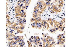 Immunohistochemistry analysis of paraffin-embedded human liver cancer using CD107b Polyclonal Antibody at dilution of 1:300. (LAMP2 anticorps)