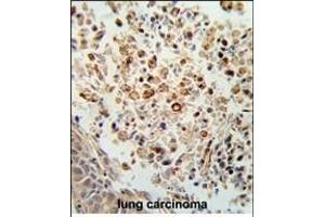 Formalin-fixed and paraffin-embedded human lung carcinoma reacted with FPRL2 Antibody (Center), which was peroxidase-conjugated to the secondary antibody, followed by DAB staining. (FPR3 anticorps  (AA 307-333))