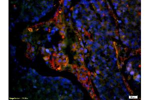 Formalin-fixed and paraffin embedded human lung carcinoma labeled with Anti-CD8 Polyclonal Antibody, Unconjugated (ABIN1385272) at 1:200 followed by secondary antibody was Goat Anti-Rabbit IgG, Cy3 conjugated used at 1:200 (CD8 anticorps  (AA 51-150))