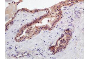 Formalin-fixed and paraffin embedded human prostate carcinoma labeled with Anti-PTGFR Polyclonal Antibody, Unconjugated (ABIN2178742) at 1:200 followed by conjugation to the secondary antibody and DAB staining