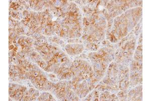 IHC-P Image Immunohistochemical analysis of paraffin-embedded SW480 xenograft, using alpha Tubulin, antibody at 1:500 dilution.