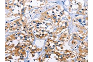The image on the left is immunohistochemistry of paraffin-embedded Human thyroid cancer tissue using ABIN7128760(CAPZA3 Antibody) at dilution 1/70, on the right is treated with fusion protein.