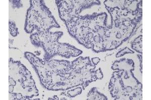 IHC staining of formalin fixed and paraffin embedded thyroid carcinoma tissue with recombinant BRAF V600E antibody. (Recombinant BRAF anticorps  (Val600Glu-Mutant))