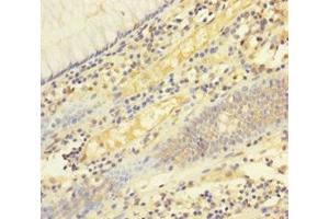 Immunohistochemistry of paraffin-embedded human colon cancer using ABIN7173813 at dilution of 1:100 (FASL anticorps  (AA 103-281))