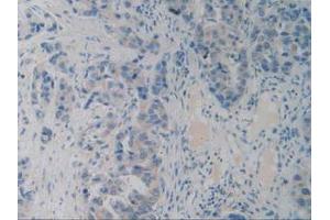 IHC-P analysis of Human Breast Cancer Tissue, with DAB staining. (PACAP anticorps  (AA 17-176))