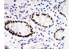 Immunohistochemical analysis of paraffin-embedded colon cancer tissues (ETV4 anticorps  (Internal Region))