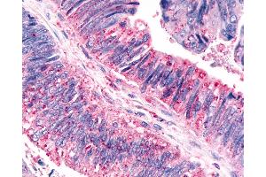 Anti-CELSR3 antibody IHC of human Colon, Carcinoma.