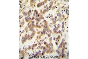 CT173 antibody (Center) immunohistochemistry analysis in formalin fixed and paraffin embedded human testis carcinoma followed by peroxidase conjugation of the secondary antibody and DAB staining. (C20ORF173 anticorps  (Middle Region))