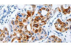 Immunohistochemistry of paraffin-embedded Human lung cancer using BPIFB3 Polyclonal Antibody at dilution of 1:120 (BPIFB3 anticorps)