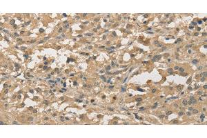 Immunohistochemistry of paraffin-embedded Human thyroid cancer using ALDH8A1 Polyclonal Antibody at dilution of 1:30