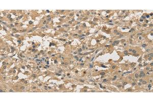 Immunohistochemistry of paraffin-embedded Human thyroid cancer using ALDH8A1 Polyclonal Antibody at dilution of 1:30 (ALDH8A1 anticorps)